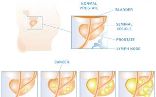 Причины и симптомы рака предстательной железы