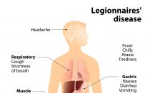 Легионеллёз и легионелла: механизм развития заболевания Лечение легионеллеза у взрослых