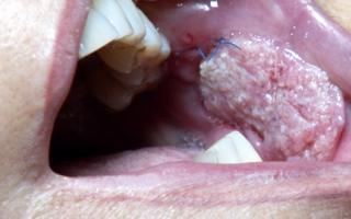 Признаки и симптомы рака во рту, причины развития – кто в группе риска развития онкологии в полости рта?